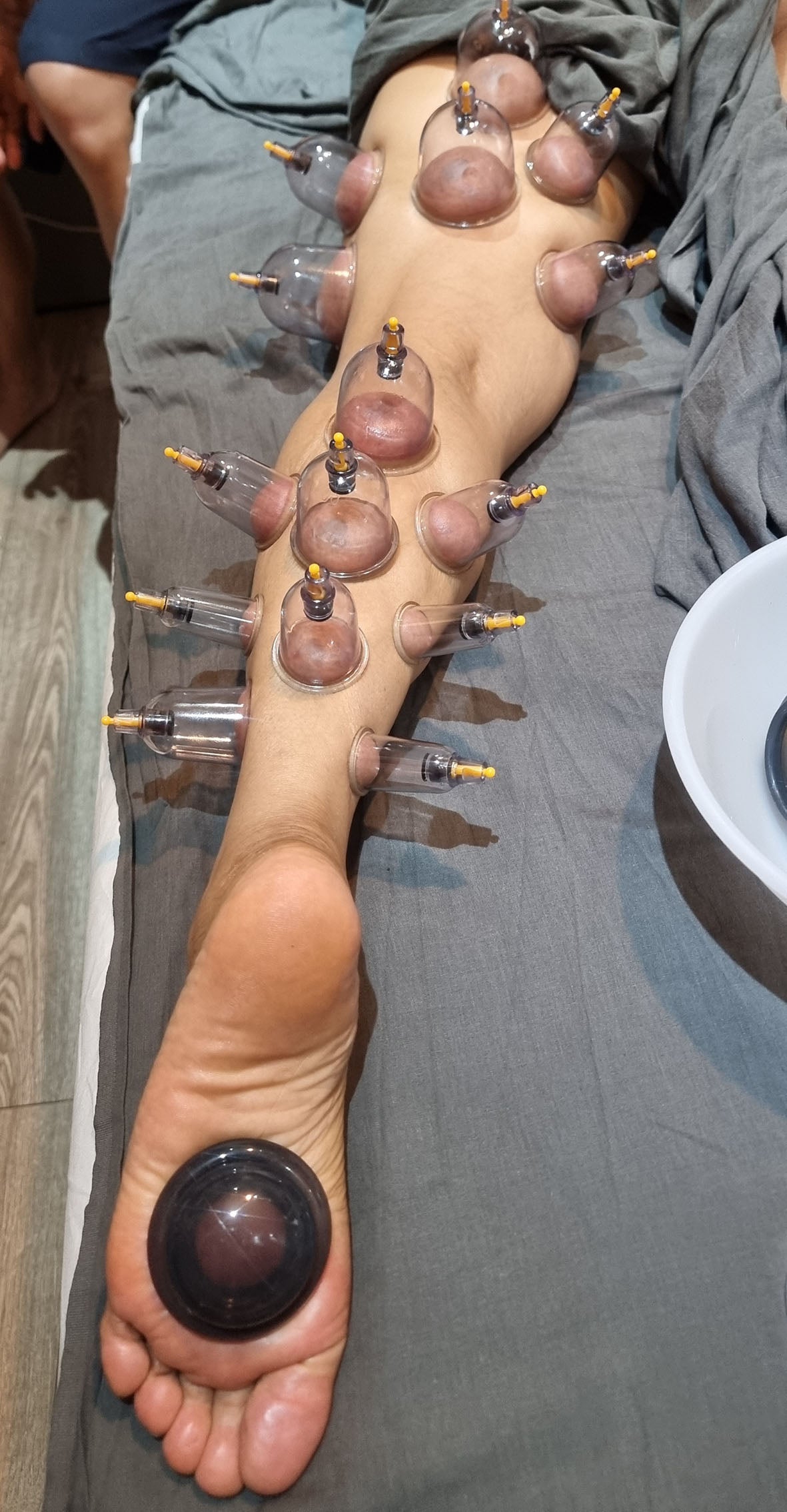 DRY CUPPING THERAPY (UPTO 20 CUPS)