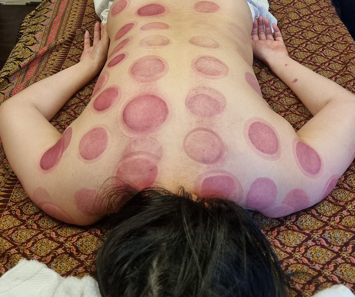 DRY CUPPING THERAPY (UPTO 20 CUPS)